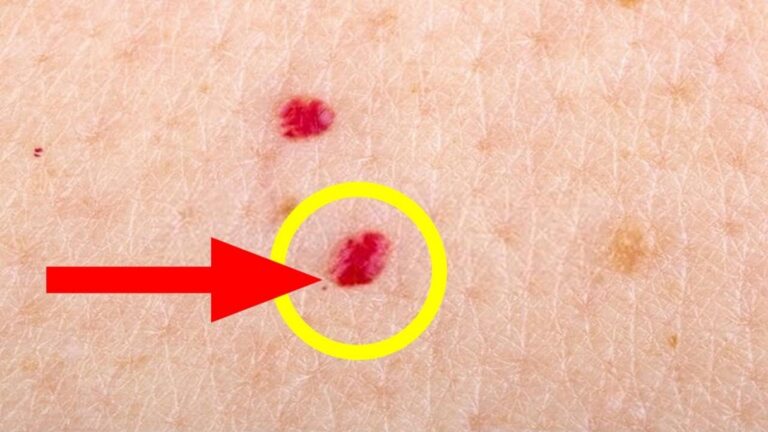 Dieser einfache Trick lässt rote Punkte auf der Haut sofort verschwinden …